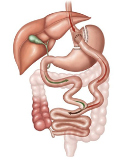 Medical illustration of gastric bypass 