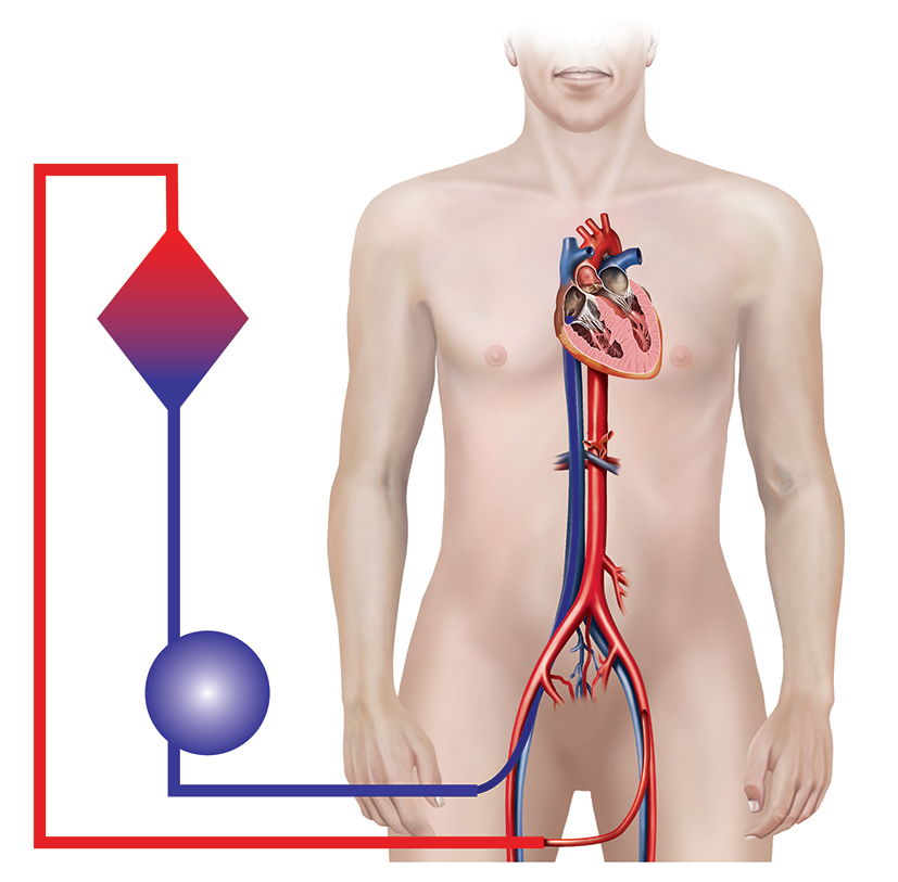 A graphic depicts veno-arterial ECMO.