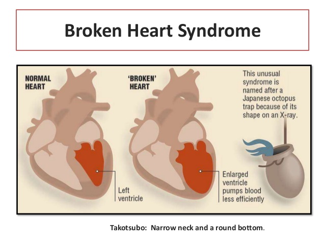 Broken heart syndrome