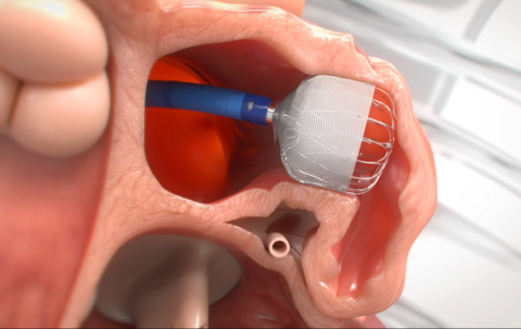 Left atrial appendage closure 