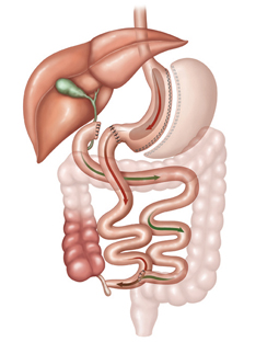 Medical illustration of duodenal switch