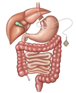 Medical illustration of gastric banding