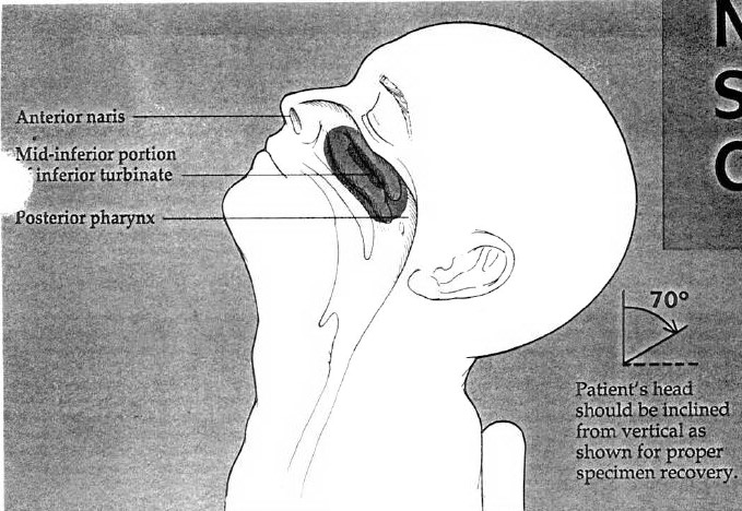 patient's head should be inclined from verticle 70 degrees for proper specimen recovery