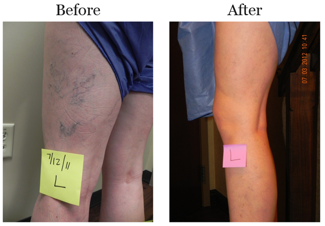 Before and after photos of superficial sclerotherapy