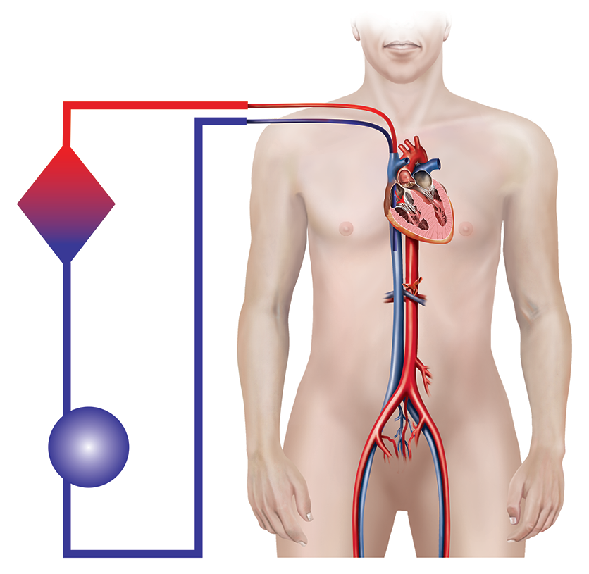 A graphic depicts veno-venous ECMO.