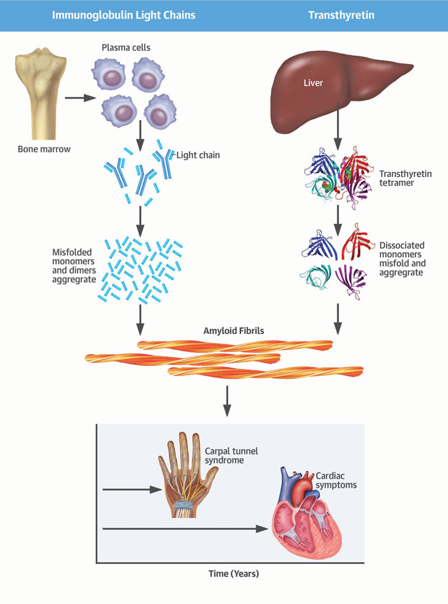 An illustration of amyloidosis