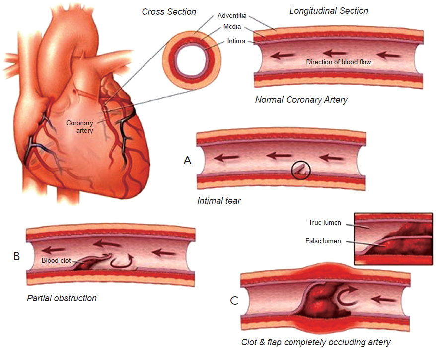 Medical Illustration for Spontaneous Coronary Artery Dissection (SCAD)