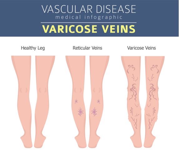 Varicose Veins | Saint Luke's